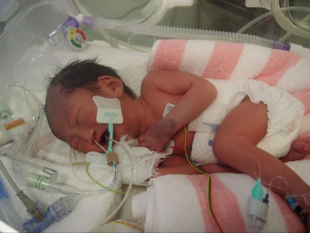 NICUで保育器に入った生後2日目の赤ちゃん。人工呼吸器や点滴経管栄養が挿入されている
