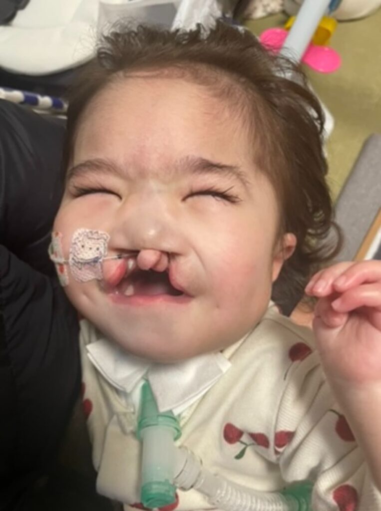 1歳9ヶ月の13トリソミーの女の子　鼻から経管栄養を挿入していて
口唇口蓋裂がある。