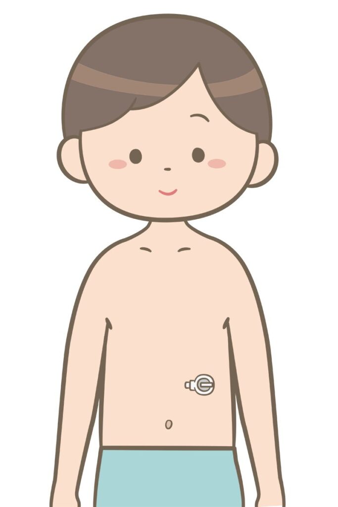 ボタン型の胃ろうを挿入している子供のイラスト