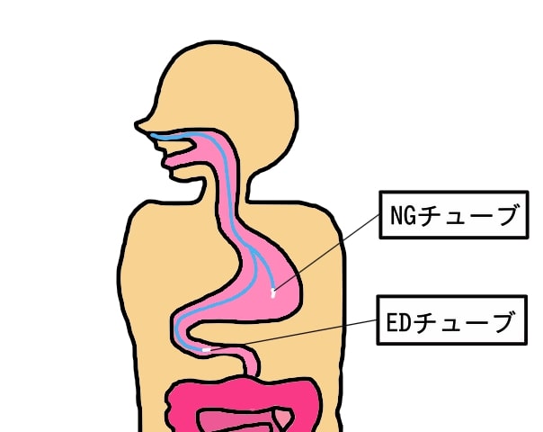 経鼻胃管栄養と経鼻腸管栄養の違い
を表したイラスト