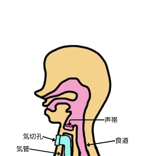 気管を遮断して気切孔を作り、気管と口の中を完全に分けてしまう方法である気管分離術を表したイラスト