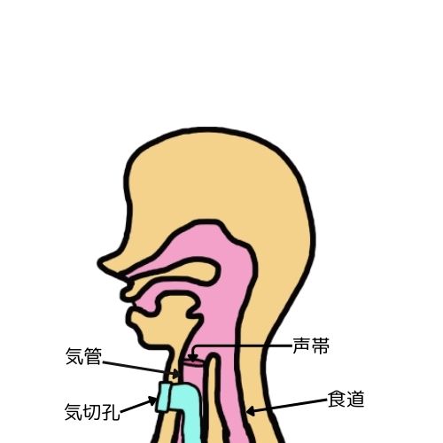 気管切開のイラスト

