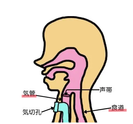 気管切開時の首の断面図。気管・気切孔・声帯・食道の位置関係を示している図